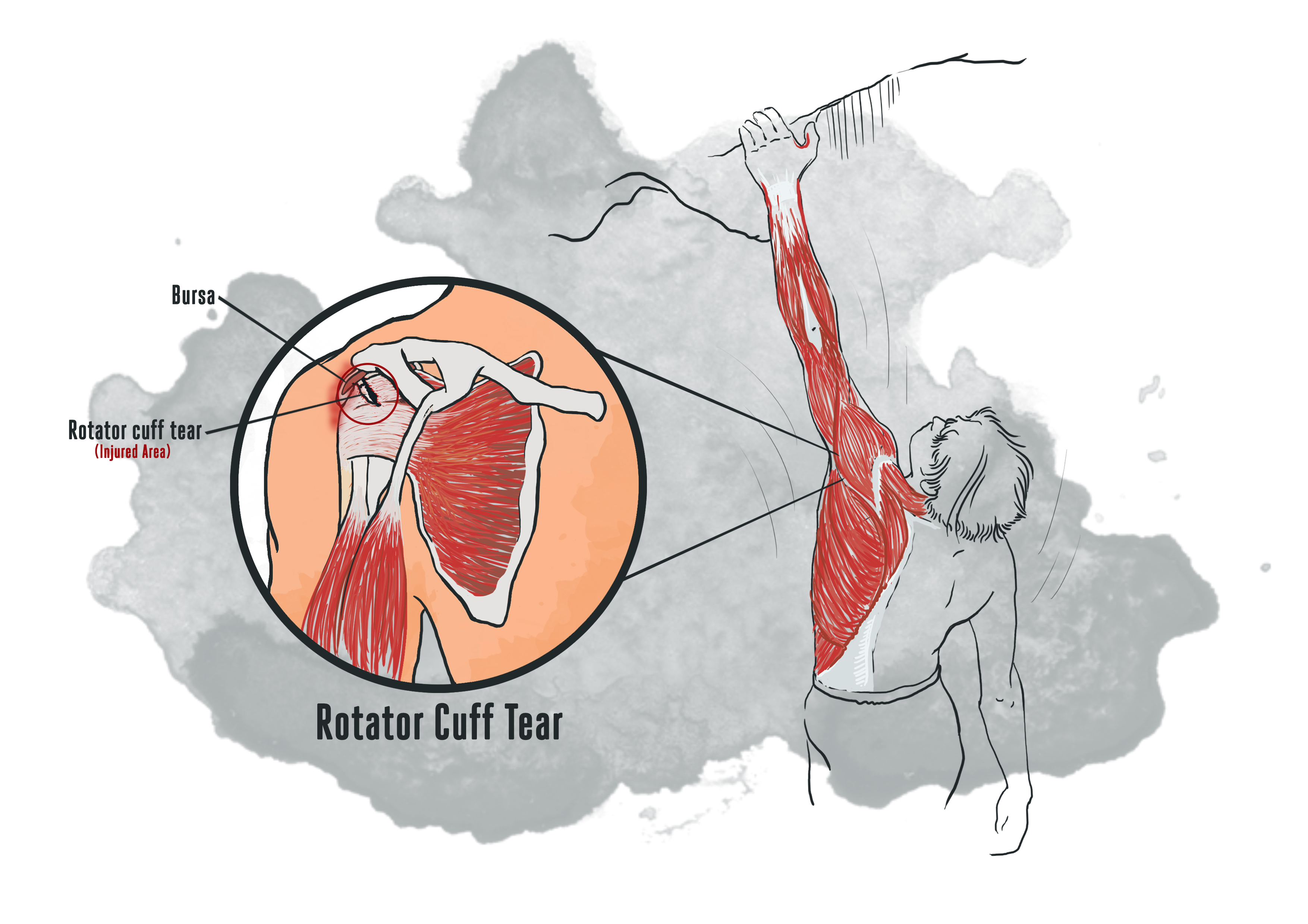 A rotator cuff tear on the left shoulder of a climber after executing a dyno. Illustration: Naveed Hussain